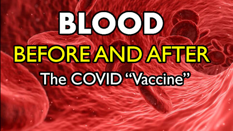 Vetted Images - Blood Before and After the mRNA COVID "Vaccine" Shot