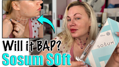 Sosum Soft... Is it Filler? Will it BAP? From www.acecosm.com | Code Jessica10 Saves you Money!