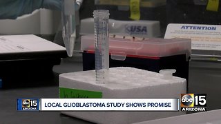 Local Glioblastoma study shows promise