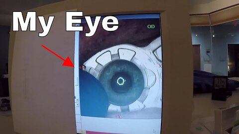 I Filmed my Lasik Eye Surgery-A Step by Step Guide to Lasik