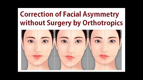 Correction of Facial Asymmetry Without Oral Surgery Using Orthotropics Method By Dr Mike Mew