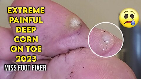 EXTREME PAINFUL DEEP CORN ON TOE 2023 PROPER TREATMENT BY FAMOUS PODIATRIST MISS FOOT FIXER