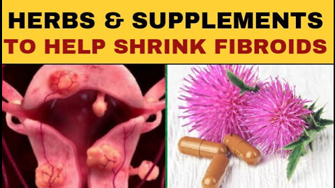 Herbs and Supplements to help Shrink Fibroids