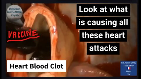 Vaccine Damage In Plain Sight: (Watch) Massive Blood Clot Being Removed From a Living Heart