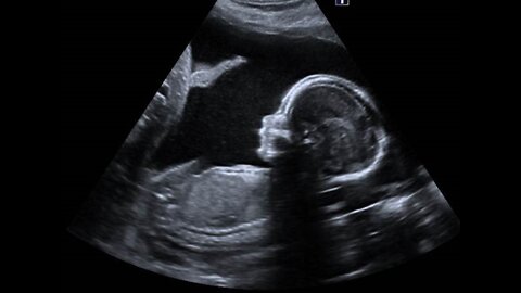 Unborn Baby Turns To Ultrasound Scan Yawning Hi'ya mom! Can’t wait to meet yah!