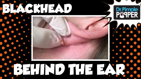 Dr Pimple Popper: You May Want to Check for BLACKHEADS Behind Your Ears...