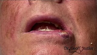 How well can lip lesions heal?