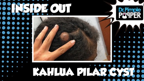 Inside Out Kahlua Pilar Cyst