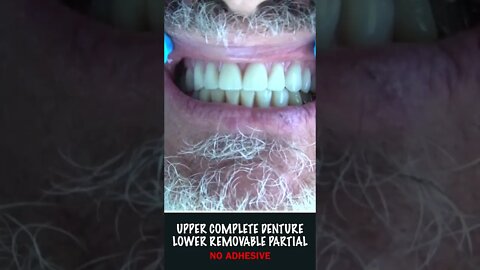 Upper Complete Denture / Lower Removable Partial Denture