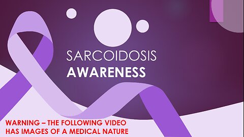 My journey to a cure for Sarcoidosis