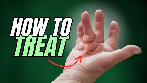 Dupuytren's Contracture (Starts as Lump on Hand) How to Treat
