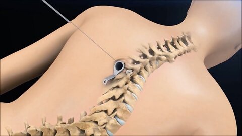 Amazing Surgery To Fix Curved Spine (Scoliosis) - Animation