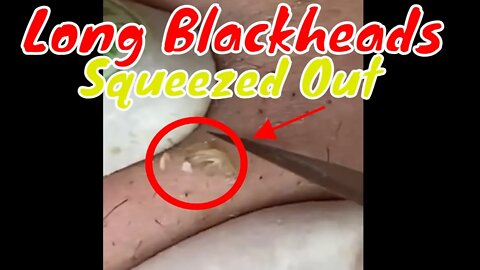 Long blackheads poked & squeezed out 🪱 #blackheadremoval #blackhead #blackheads #blackheadsremoval