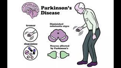 Treating Parkinson's disease with diet.