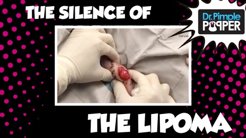 The Silence of the Lipoma with Dr Pimple Popper & Carina Berg