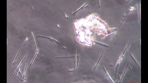 The Live Blood Containing Graphene, Parasites, Spike Protein, Acid Crystals & Polymerized Protein