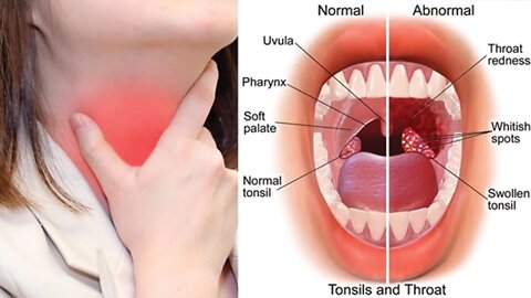 6 Best Home Remedies for Tonsillitis