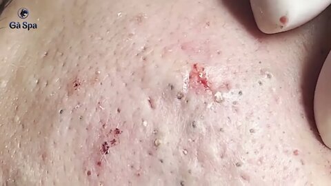 Removal / Extraction Super Blackheads!!!!
