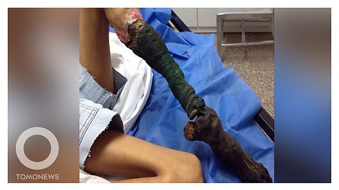 Snake bite rots away Venezuelan girl's leg - TomoNews
