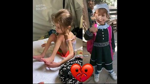 The little girl Jana Ayyad suffers from malnutrition as the aggression continues against Gaza.