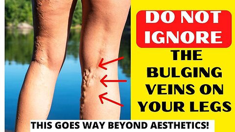 The Hidden Dangers of Varicose Veins (Complications, Prevention & Treatment Options)