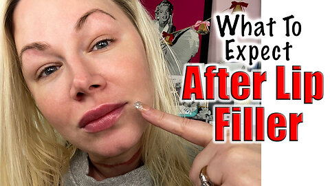 What to Expect after Lip Filler | Code Jessica10 saves you Money