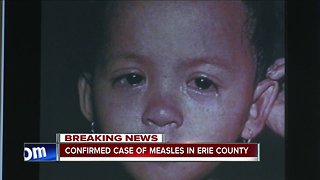 Confirmed case of measles in Erie County