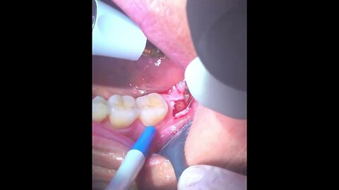 Jawbone surgery showing fat globules & purulent discharge from the jawbone of a patient.