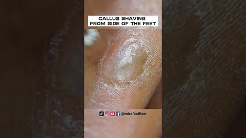 LARGE CALLOUS SHAVING 2023 | CALLUS SHAVING FROM SIDE OF THE FEET ( SATISFYING) BY MISS FOOT FIXER