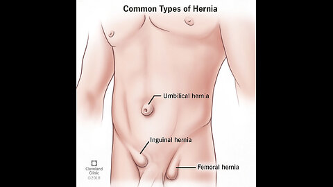 Hernia 3D Animation Video