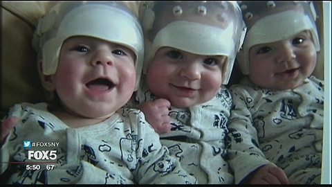 Triplets Were Born with a Very Rare Birth Defect. Here's What was Underneath Those Helmets.