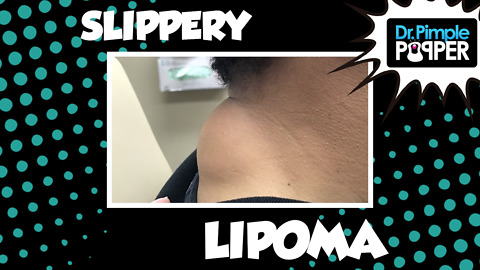 A Crumbly and Slippery Lipoma