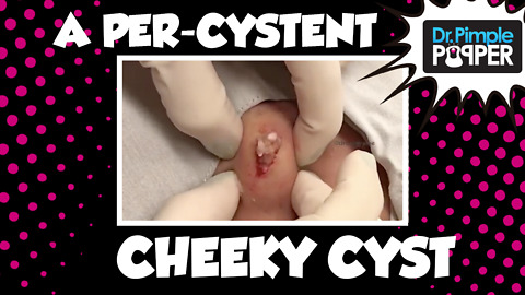 A PerCystent Cheeky Cyst