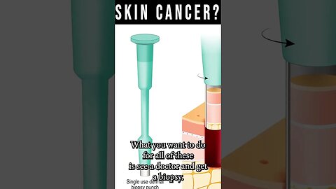 Early Stage Skin Cancer Signs [Skin Cancer Biopsy & Moh's Surgery]