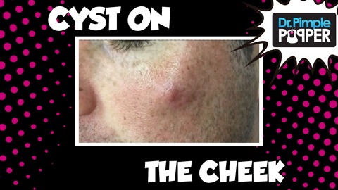 First Try with New Camera! A Cyst Excised on the Left Cheek