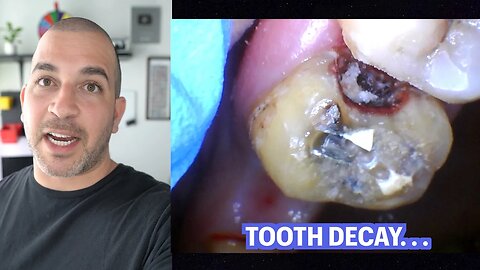 Monster Tooth Decay under Dental Bridge {Procedure Review}
