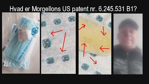 Viktors Verden: Der er 'Morgellons' 'orme' i maskerne (mundbind) [05.04.2021]