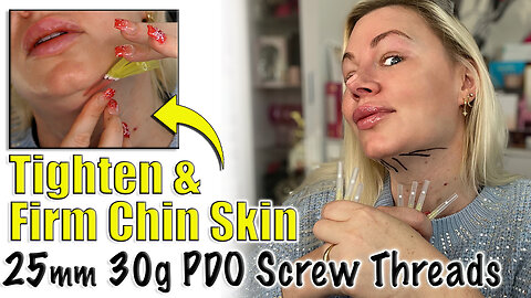 Tighten & Firm Chin Skin with 25mm 30g PDO Screw Threads, AceCosm | Code Jessica10 saves you money