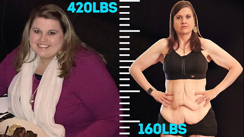 I Lost 260lbs But Gained 20lbs Of Excess Skin | BRAND NEW ME