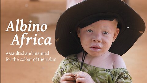 Albino Africa | RT Documentary