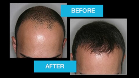 PROFALAN stop hair loss solution for men