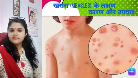 What causes Measles? And treatment. #measles #drminakshisingh #homeopathy #treatment