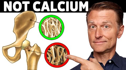 Osteoporosis Is NOT a Calcium Problem