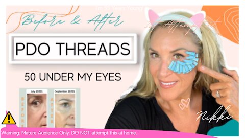 DIY PDO Threads - Under Eye Repair **BEFORE & AFTER**