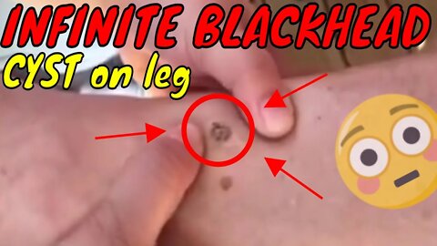 Infinite blackhead cyst on leg 😨 #blackheadremoval #cyst #blackhead #blackheads #satisfying #fyp