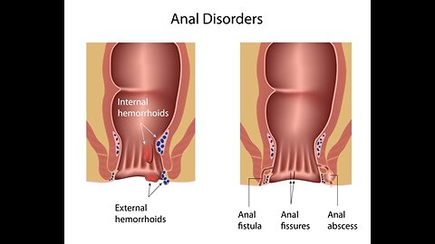 Hemorrhoid, a common disease that can be found in people of all ages