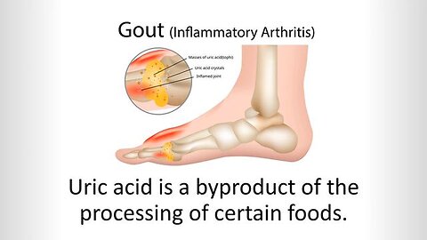 The Road to Gout Recovery: The Comprehensive Solution