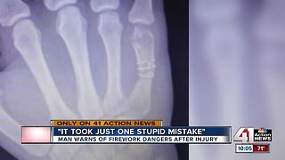 Surgeon, victim warn of firework hand injuries: 'Looked like hamburger meat'