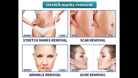 How to remove stretch marks fast