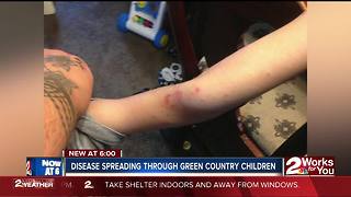 Disease spreading through Green Country children